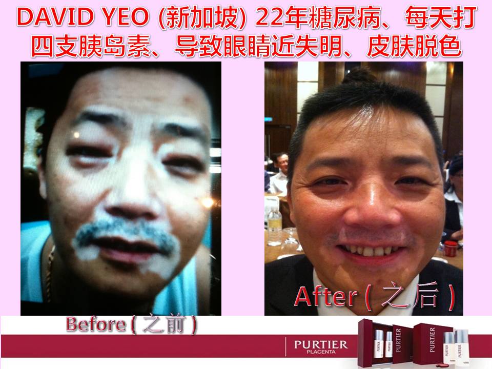 DAVID YEO (SINGAPORE)-22 Y OF DIABETES,4 INSULIN DAILY,VISION BLUR,FACE PIGMENTATION DAMAGE