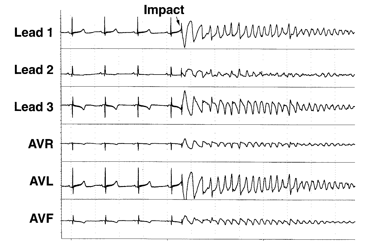 What I Learned from Daniel The Blog What Is Commotio Cordis