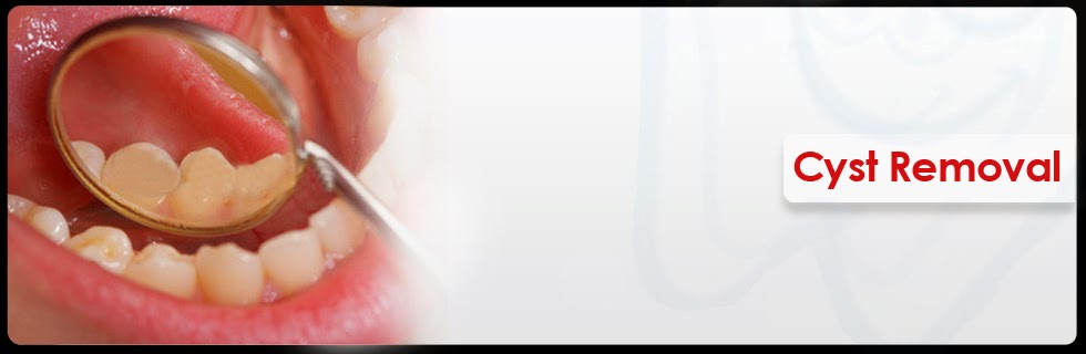 dental cyst