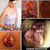 Agen Resmi Obat Wasir Ambeclear thumbnail