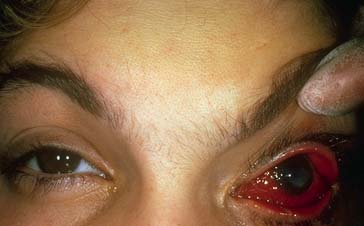 prostitute herpes
