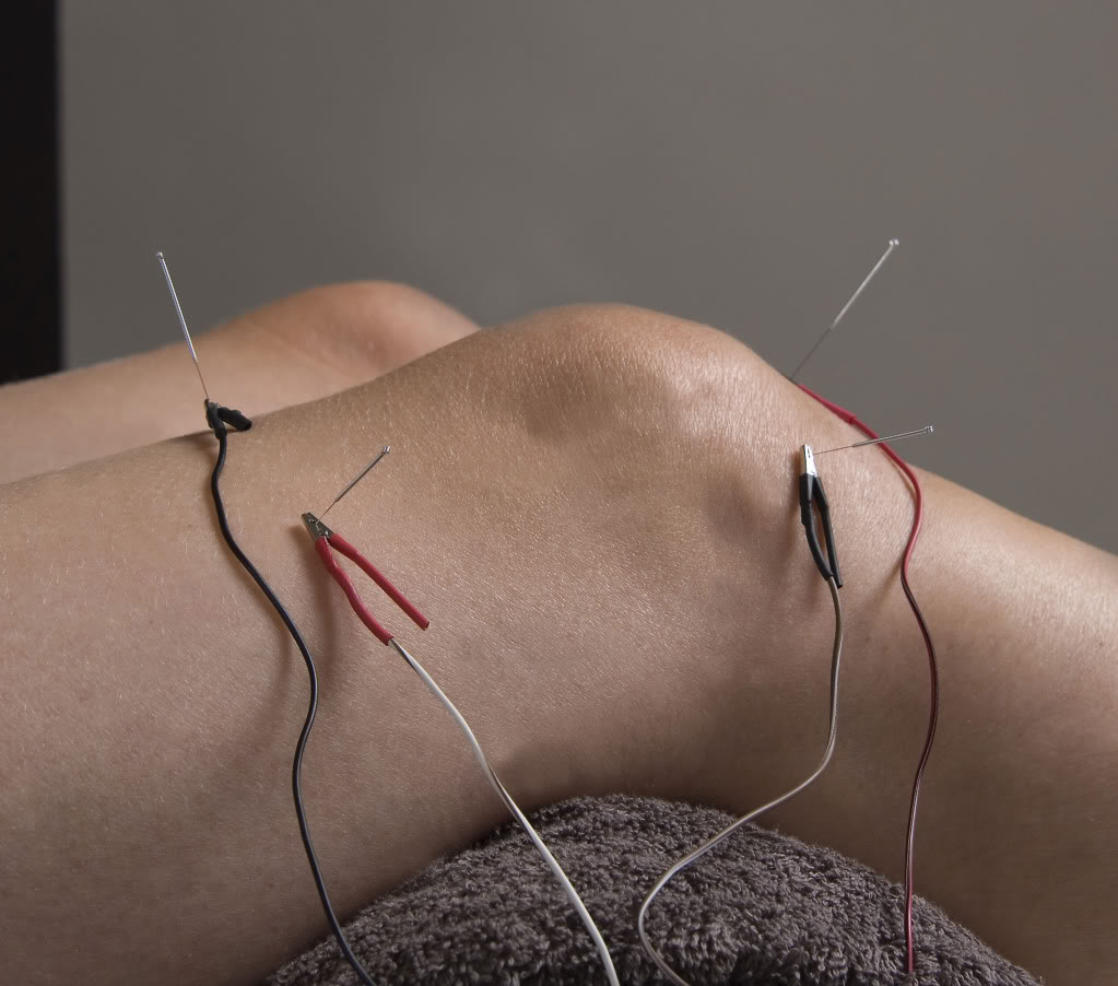 Treating Depression With Acupuncture