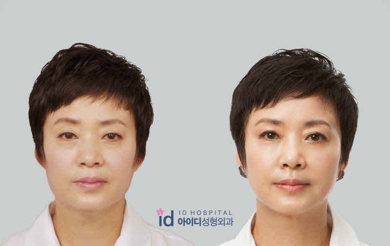 アジア最初の輪郭専門病院 韓国id美容外科です 整形症例 アンチエイジング整形の症例