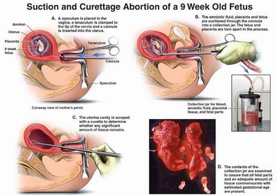 Self Induced Miscarriage