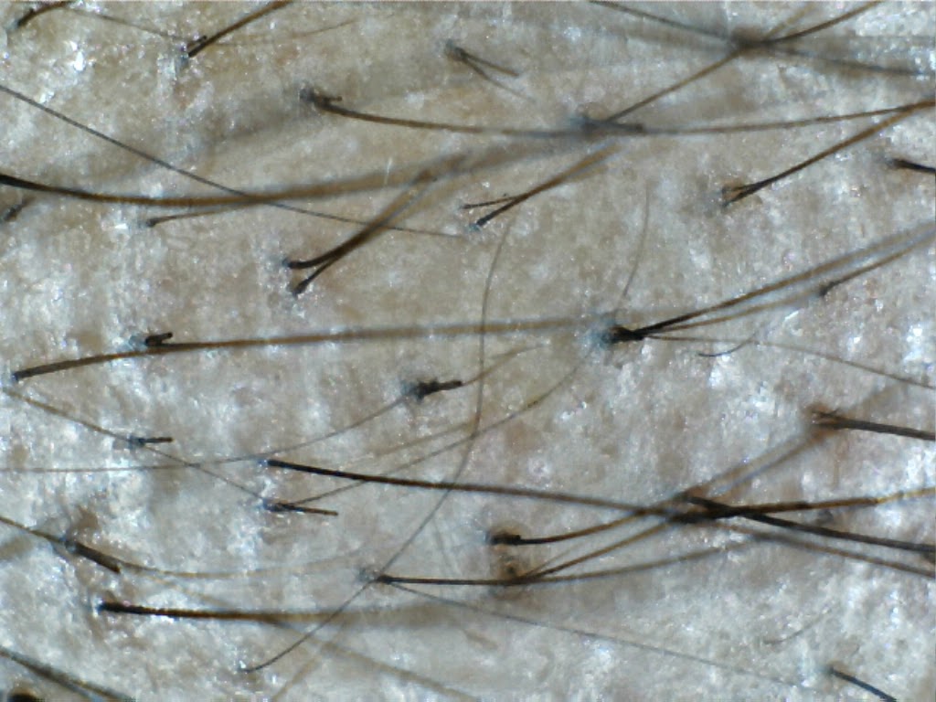 androgenic alopecia research [articles] My research and investigation