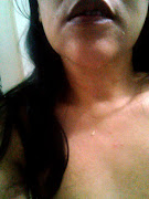 Rashes spread all over my neck and chest on third day