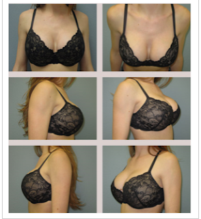 breast enhancement enlargement