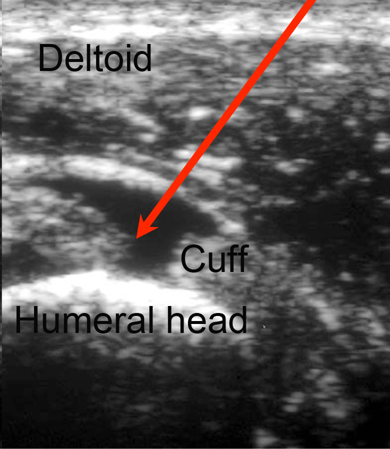 Shoulder Mri Anatomy