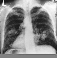 cancer poumons symptomes