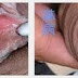 Obat ampuh atasi kencing nanah dan sipilis dengan cepat thumbnail