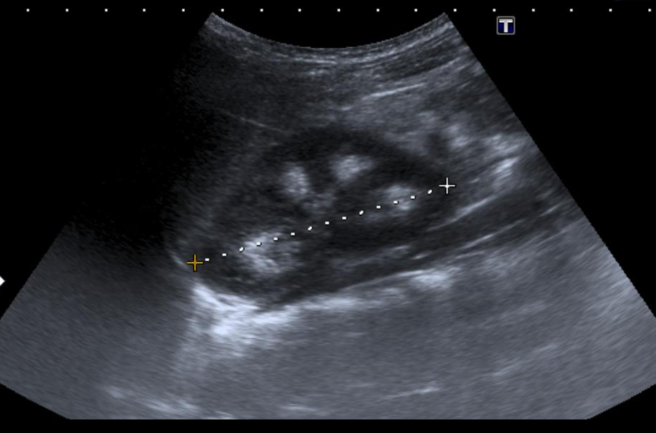 Medullary nephrocalcinosis Ultrasound Sumer's Radiology Blog