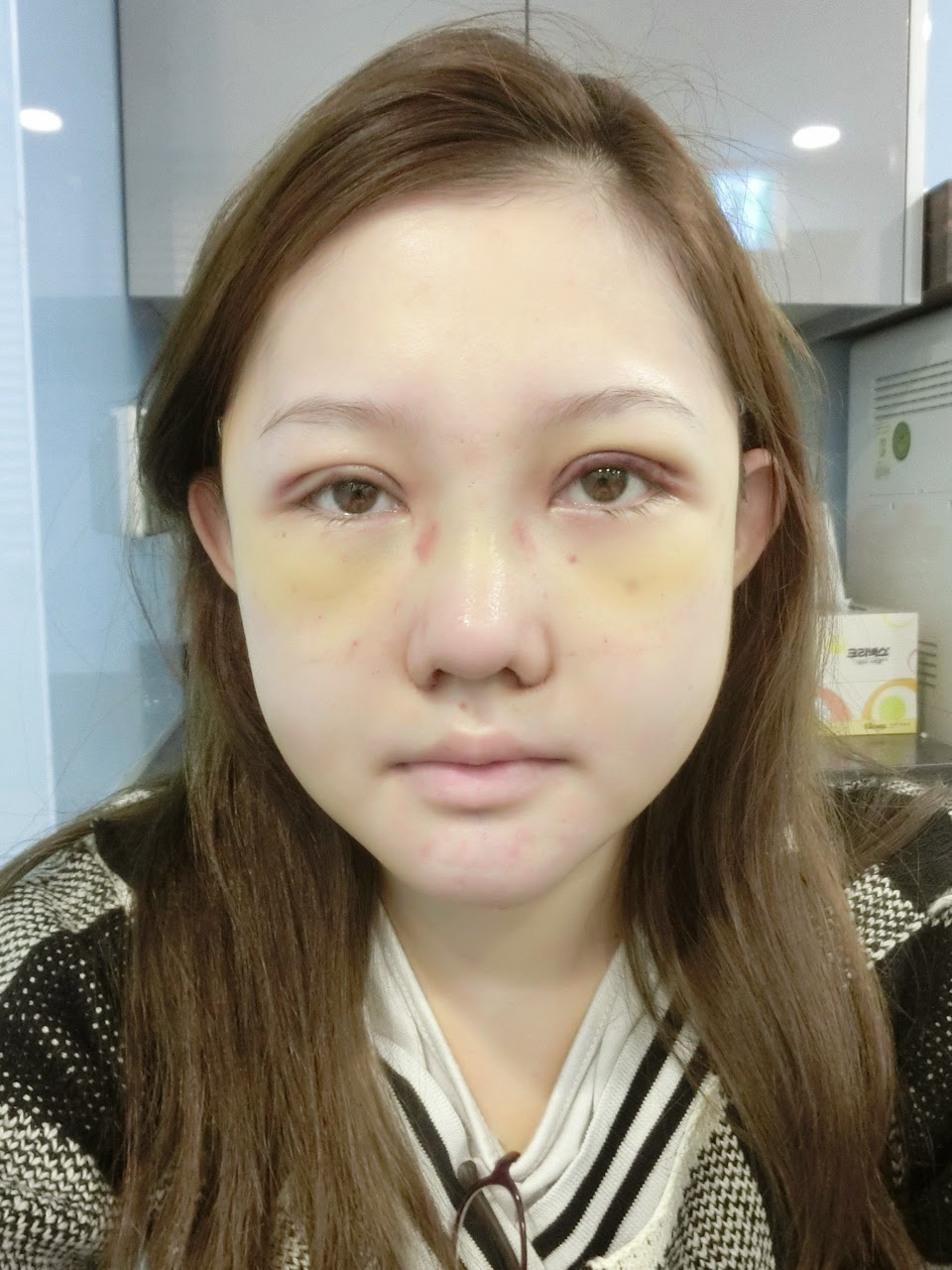 22october14-postop-7-day-gollylocks1 22october14-postop-7-day-gollylocks1