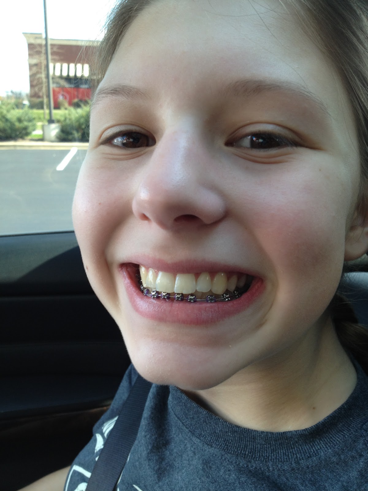teeth tighten braces getting purple band tightened straight process fun