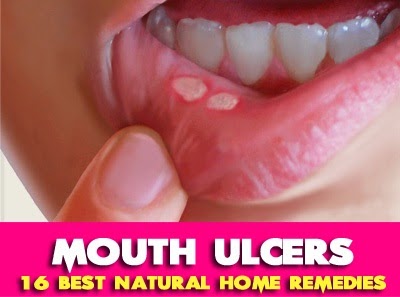 your sugar for coffee best FOR PART ULCERS/ â NATURAL REMEDIES HOME SORE BEST 1 CANKER MOUTH 16 your sugar for coffee best FOR PART ULCERS/ â NATURAL REMEDIES HOME SORE BEST 1 CANKER MOUTH 16