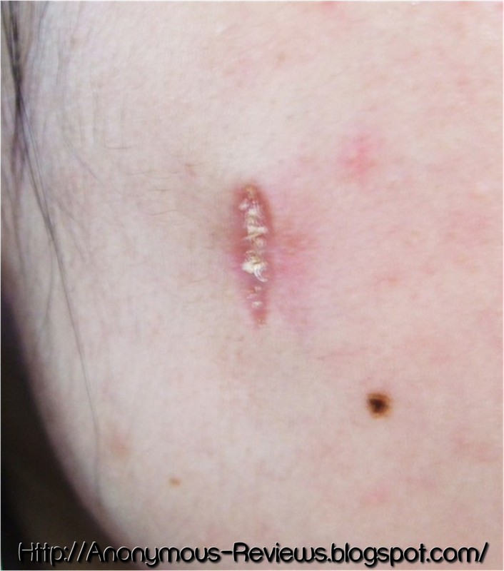 Recovery mole excision Mole Removal:
