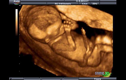 14 haftalik gebelik hamilelik goruntusu