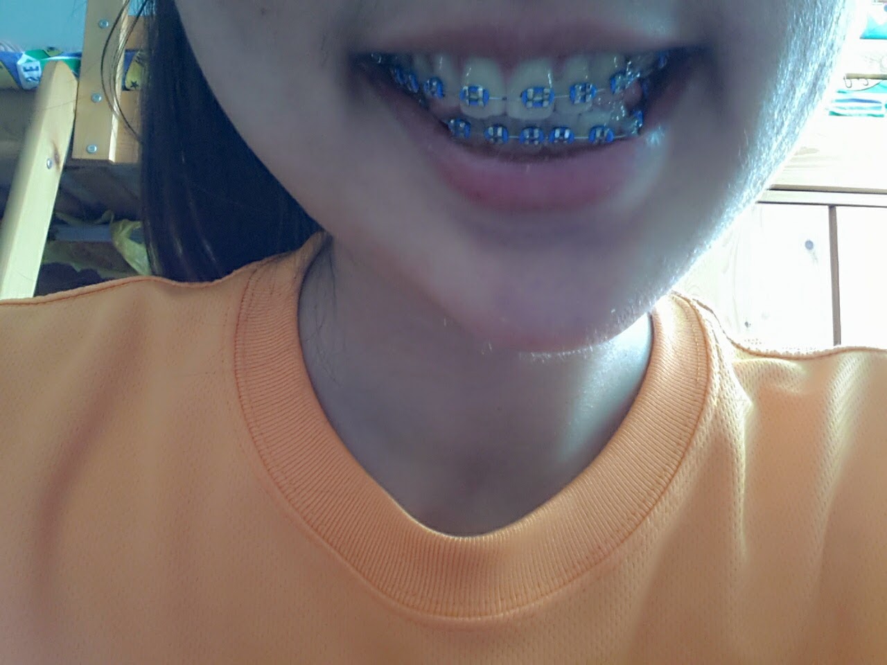 Braces Journey εlyssa ѕzεкі