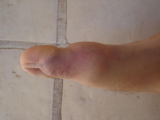 El hongo de las uñas en los pies el tratamiento por la esencia
