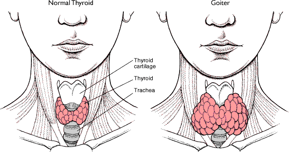 Image result for hipertiroidisme