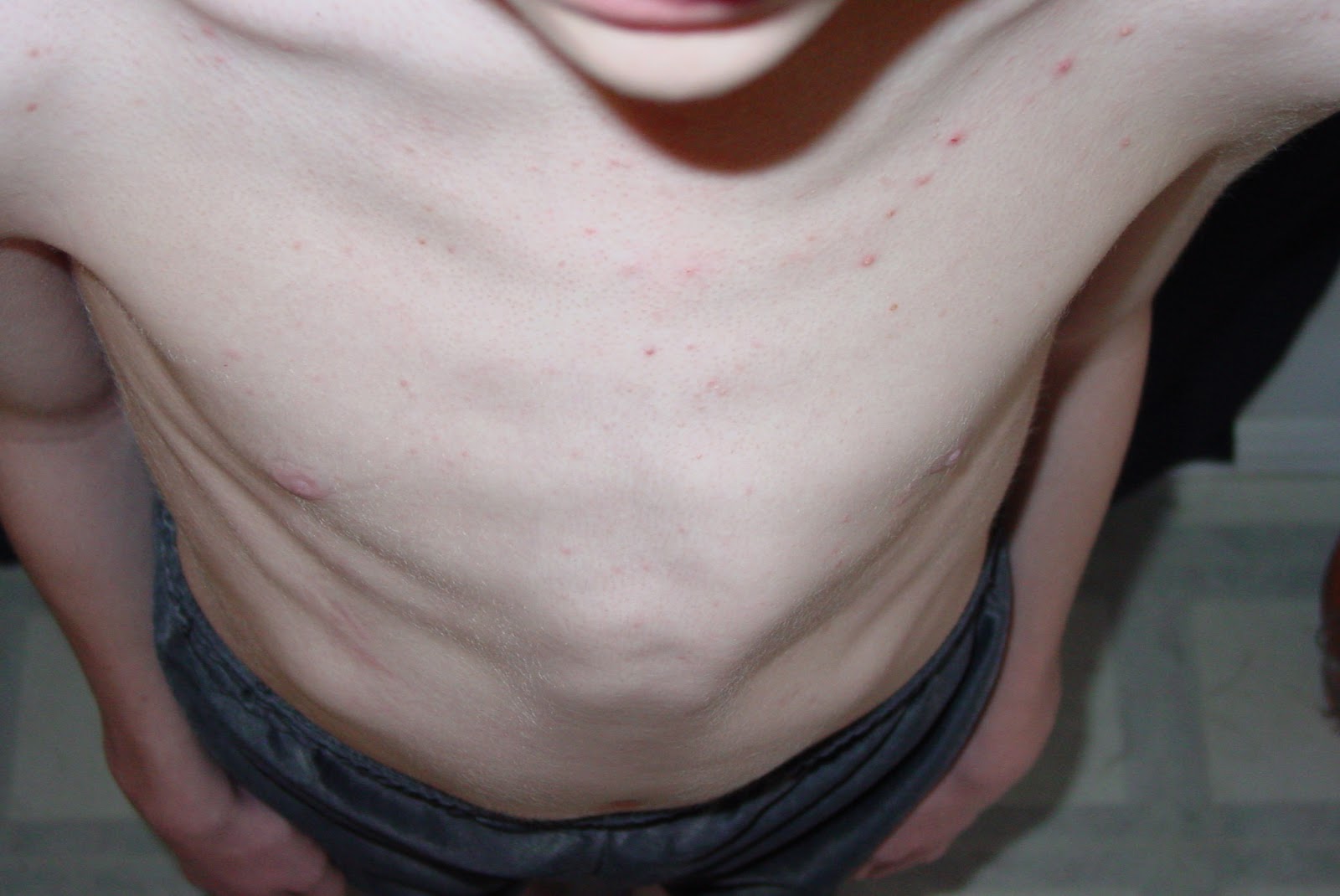 QuiltedSunshine Pectus