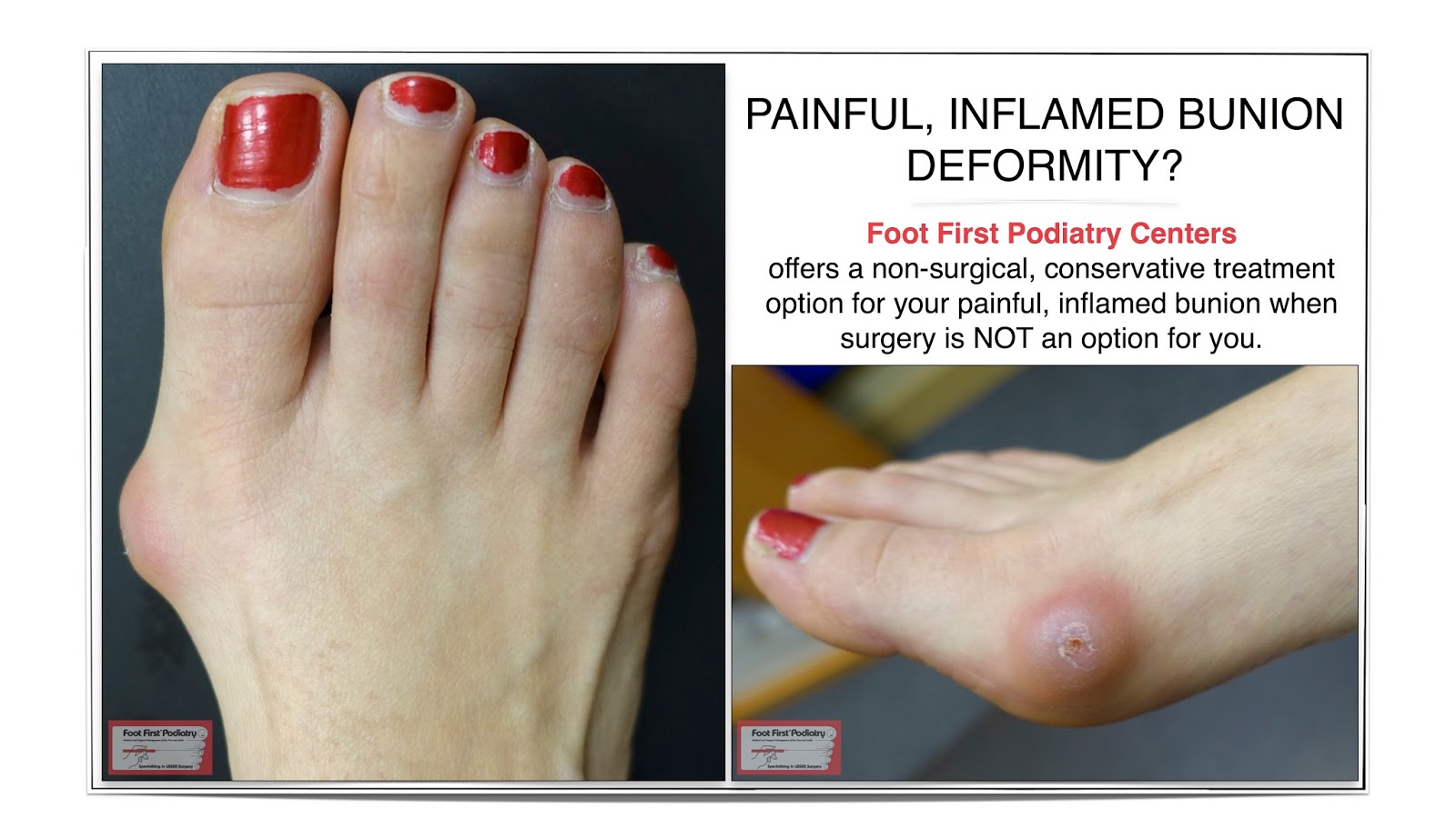 Swiss Compression Technique for Correcting Bunions