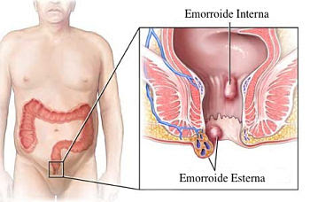 guarire dalle emorroidi in 2 giorni