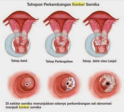 obat kanker serviks ampuh stadium 2, obat alternatif kanker serviks, obat kanker serviks alternatif