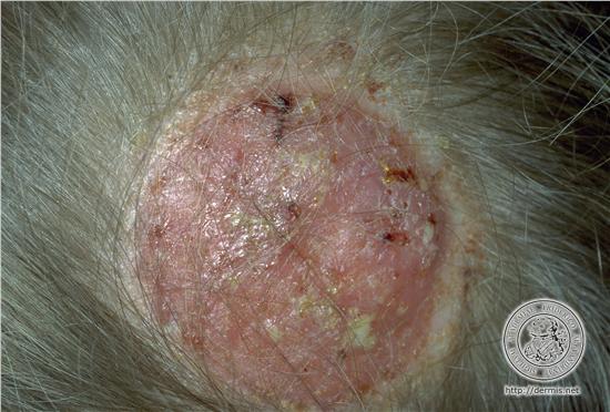 Acne em estrelas
