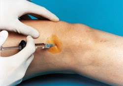 Steroid knee injection video