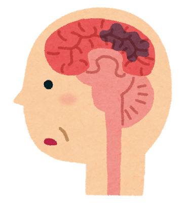 認知症の脳のイラスト（脳血管性）
