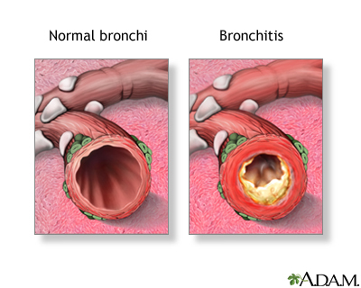Bronchitis steroids treatment