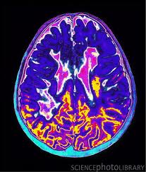 mri brain scan images ms