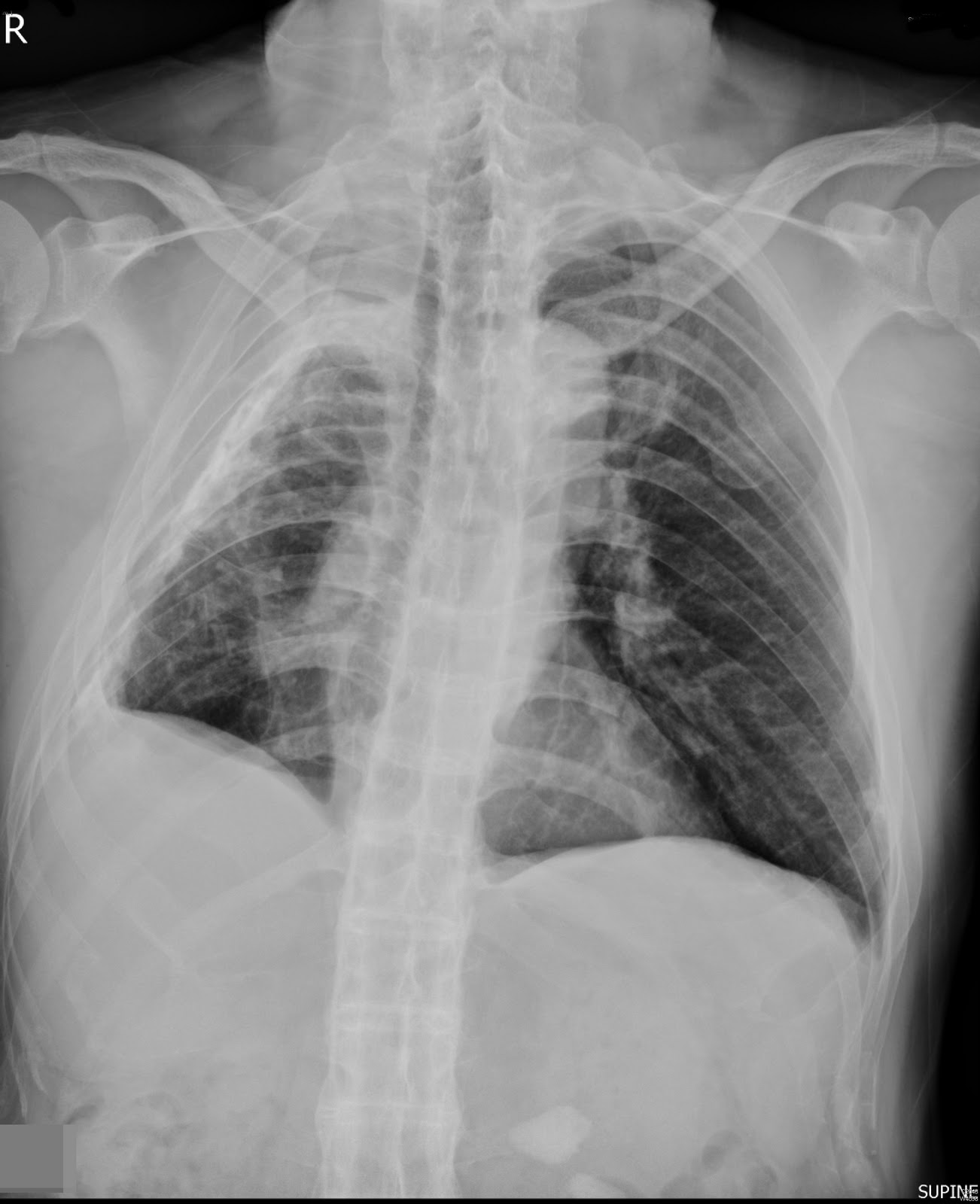 Ankylosing spondylitis emedicine 