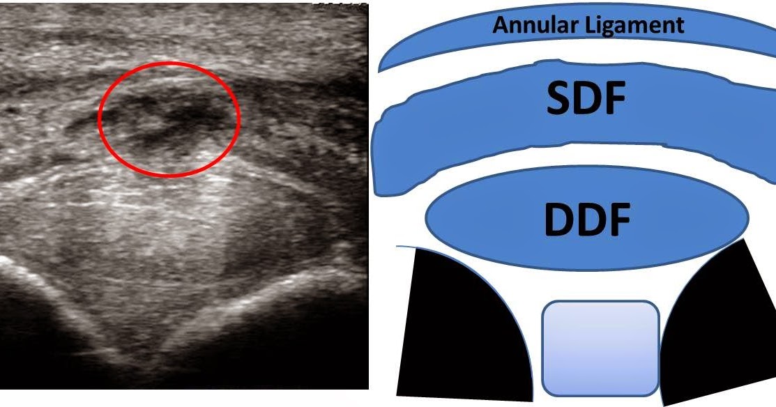 Michael Porter, Equine Veterinarian Superficial Flexor Tendonitis in a