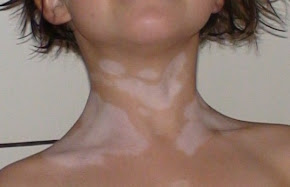 Vitiligo is an auto immune condition that results in loss of pigment in the skin.