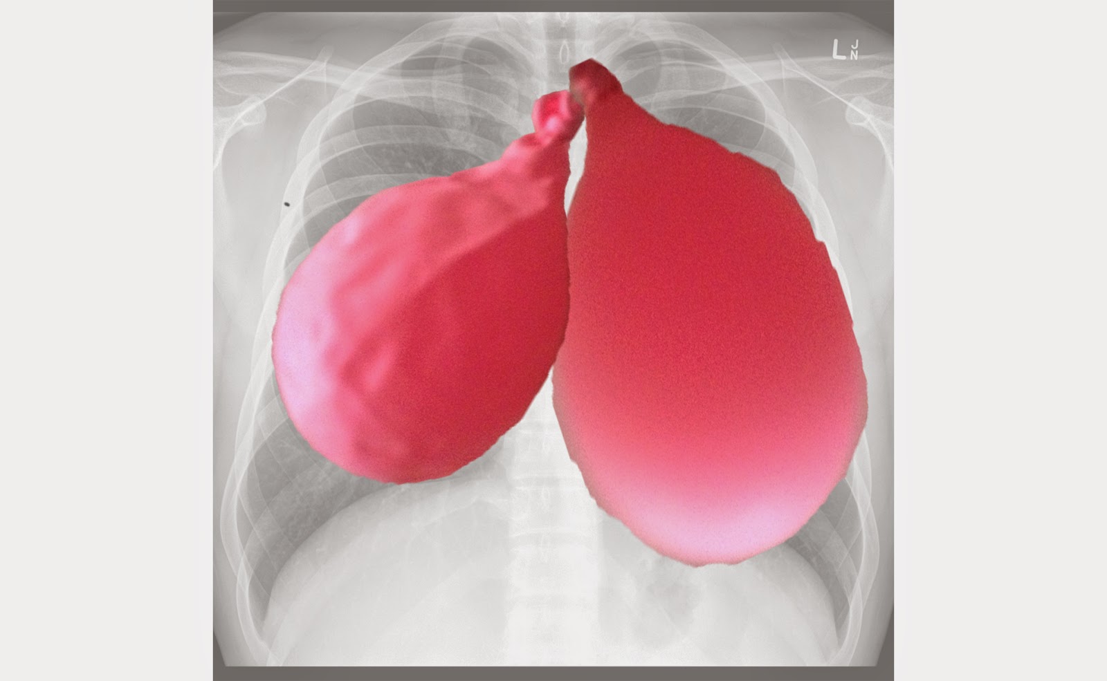 Dr. Grimes' Bottom Line Can Healthy Lungs "Collapse"?
