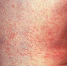 Measles Vaccine Rash