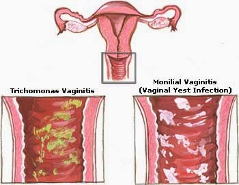  yeast infections Causes 