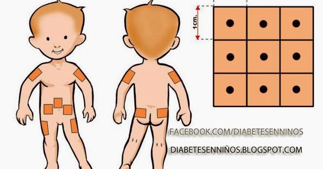DONDE SE APLICA LA INSULINA : DIABETES EN NIÑOS DONDE SE APLICA LA INSULINA : DIABETES EN NIÑOS