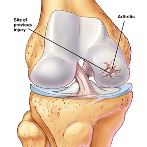 Arthritis Knee Treatment Natural