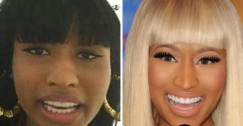 Nicki Minajoe: Nicki Minaj Plastic Surgery Before & After