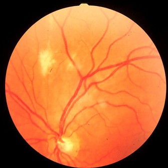 Cmv Rash Pictures