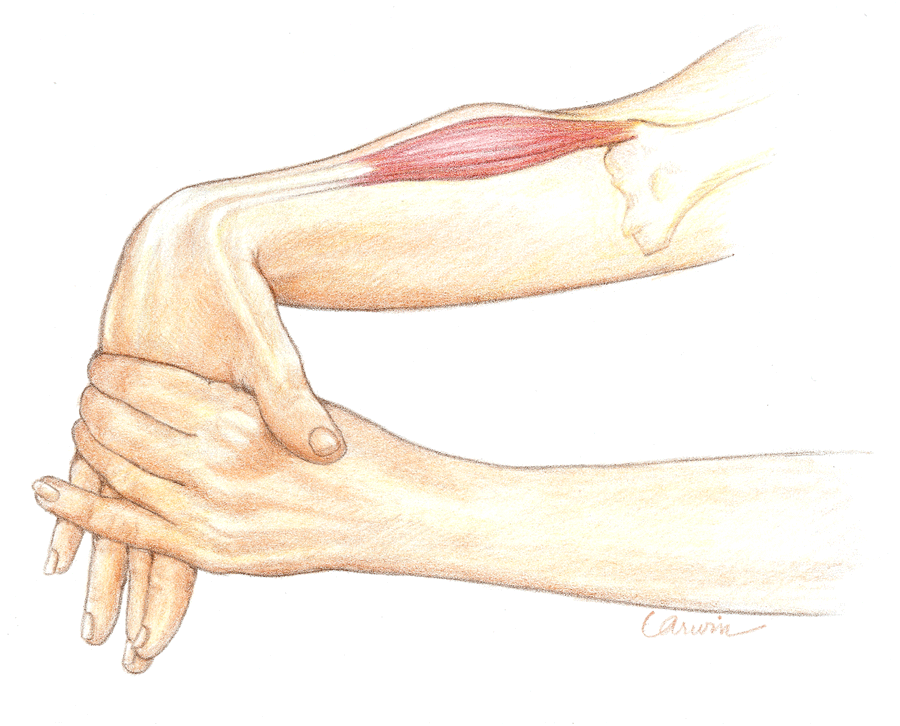 Carpal Tunnel Syndrome