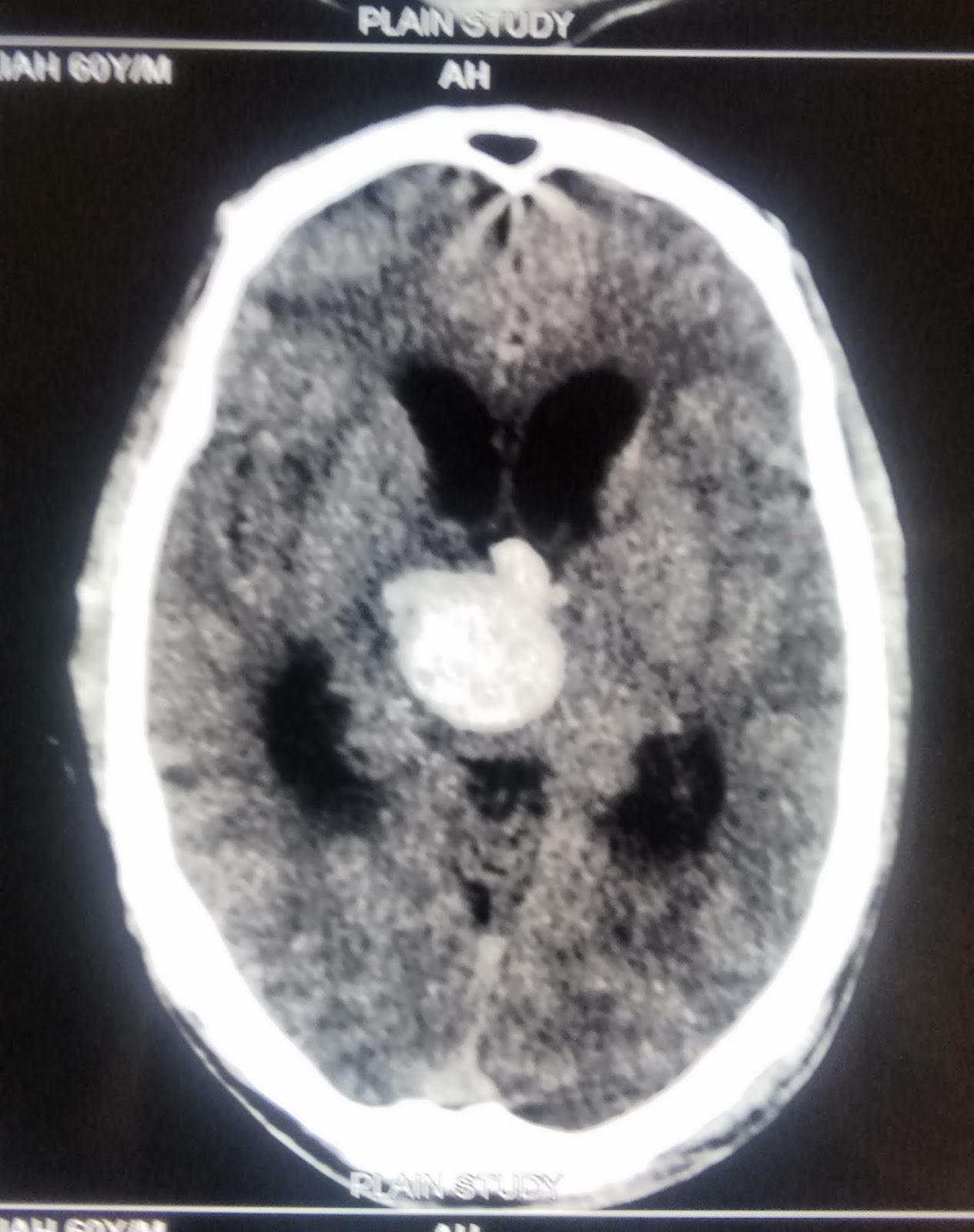 Thalamic Hemorrhage In Brain CT Scan Images Staff