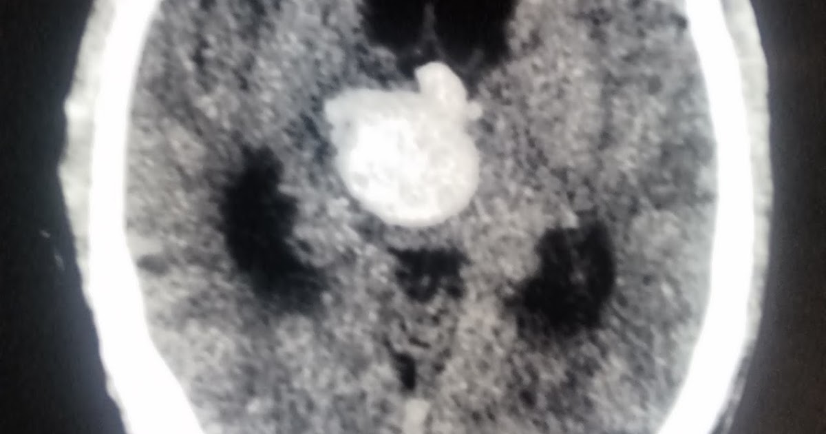 Thalamic Hemorrhage In Brain CT Scan Images Staff Nurses in India, Nurses