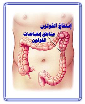 القولون العصبى اسباب - اعراض - وعلاج Treatment+colon+Nervous+herb