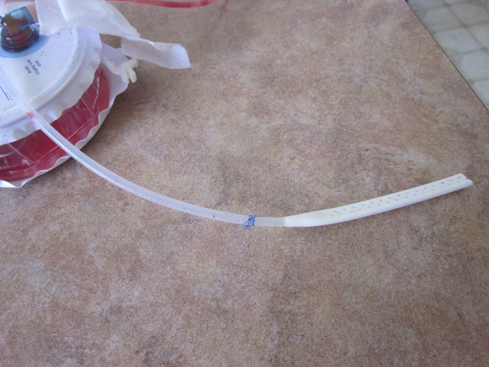 Mastectomy June 2015