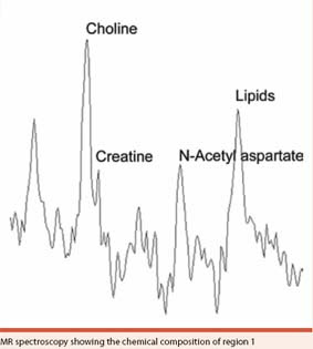 Normal Brain Spectroscopy