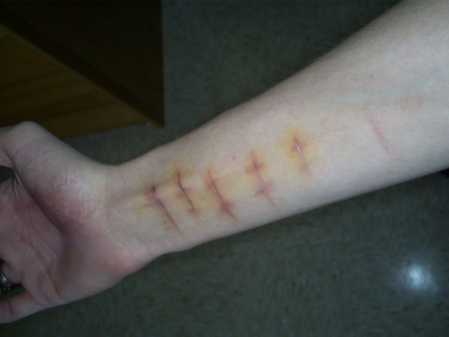 Cut Of Arm
