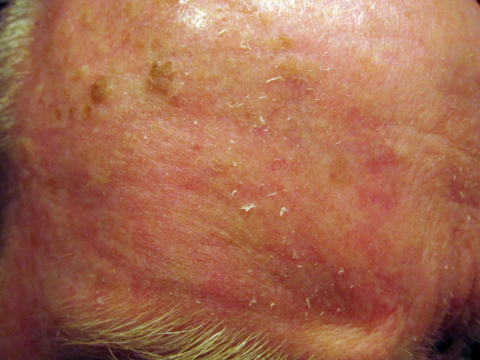 Efudex Round Two Day 29 (Recovery Day 15)